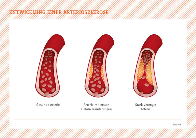 Entwicklung einer Arteriosklerose - Infografik