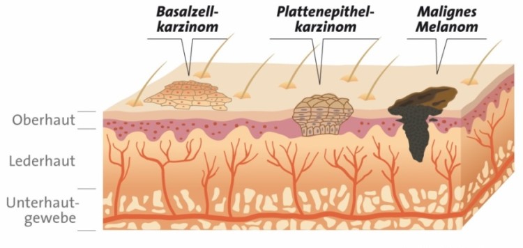Verschiedene Formen von Hautkrebs - Infografik