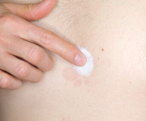 Mann behandelt Brust mit Hautpilz(Foto © Fotolia/lavizzara)