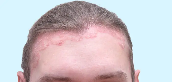 schuppenflechte-auf-dem-kopf-702x336.jpg.webp