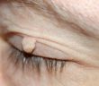 Stielwarze (Fibrom) am Augenlid