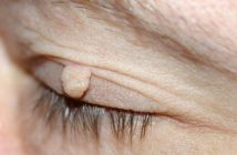 Stielwarze (Fibrom) am Augenlid