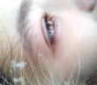 Okuläre Rosacea - Wenn die Krankheit die Augen betrifft