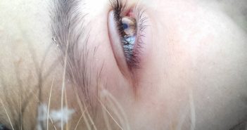 Okuläre Rosacea - Wenn die Krankheit die Augen betrifft