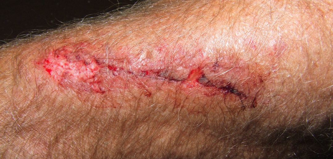Blutvergiftung am Arm rechtzeitig erkennen LZ Gesundheitsreport
