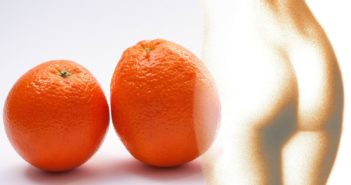 Cellulite - Ursachen, Symptome und Behandlung