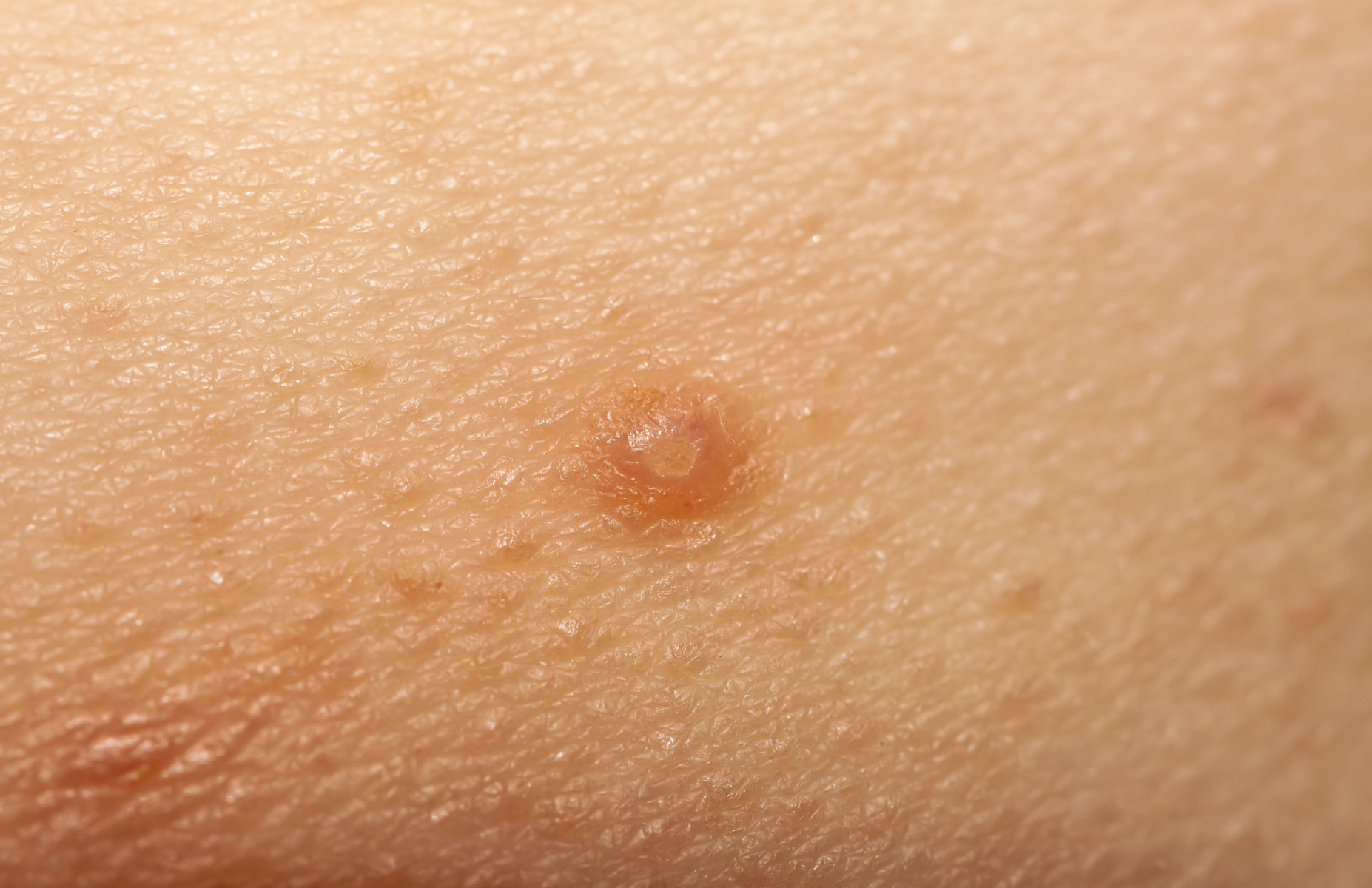 Ist hpv vírus ansteckend,