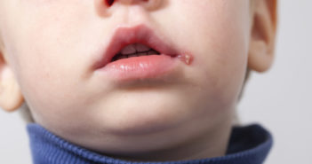 kleiner Junge mit Lippenherpes