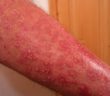 Schuppenflechte / Psoriasis am Arm