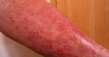 Schuppenflechte / Psoriasis am Arm