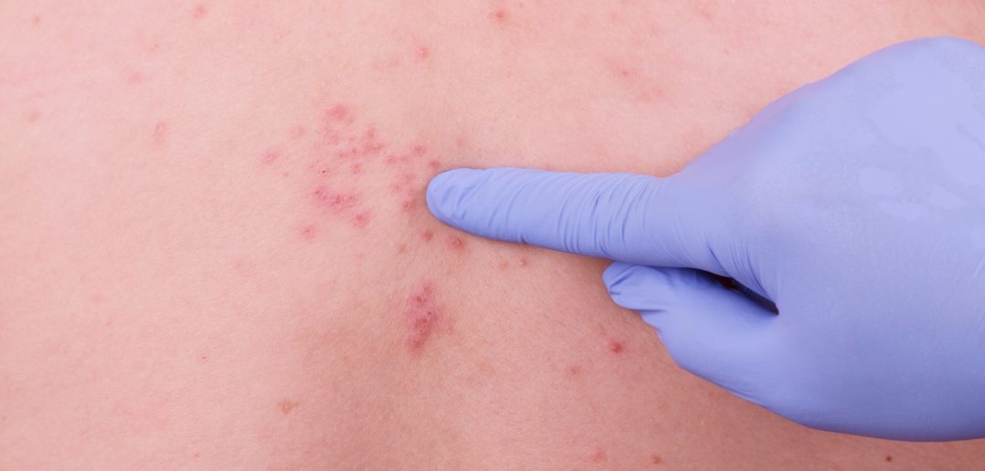 Krankheitsverlauf & Stadien der Gürtelrose | LZ Gesundheitsreport