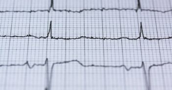 EKG eines menschlischen Herz
