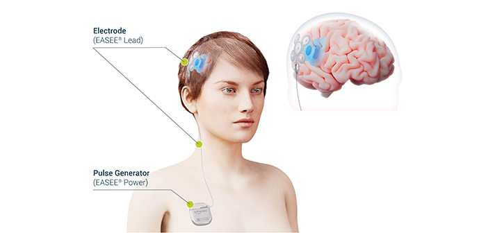 Schemazeichnung, wie Elektrodenstimulation auf das Gehirn einwirken kann.