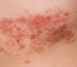 Gürtelrose: Ausschlag auf der Haut