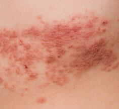 STIKO senkt Empfehlung für Gürtelrose-Impfung auf 18 Jahre