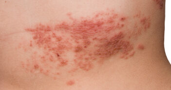 Gürtelrose: Ausschlag auf der Haut