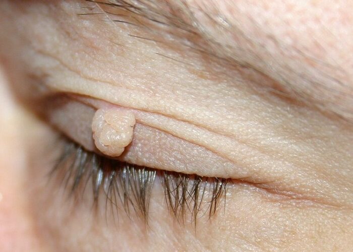 Stielwarze (Fibrom) am Augenlid